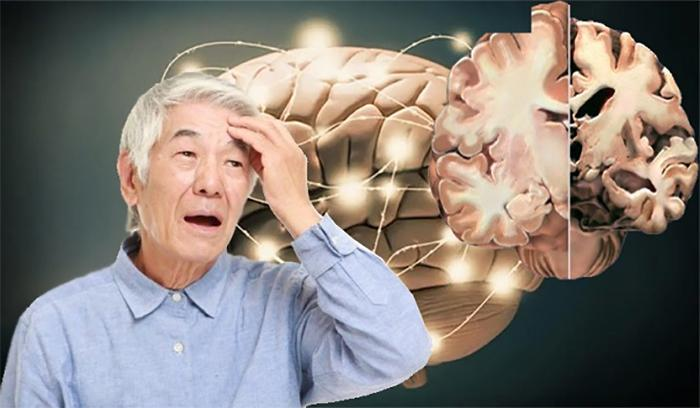Giảm chứng mất trí nhớ của bệnh Alzheimer với thuốc trị đa xơ cứng - Ảnh 1